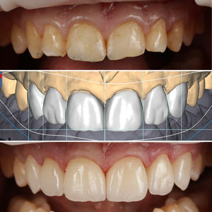 Dental Restoration Process