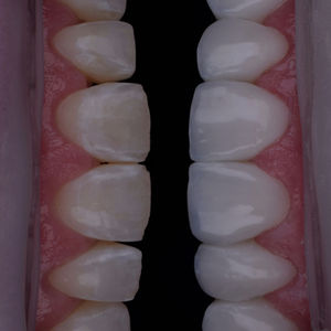 Teeth Alignment