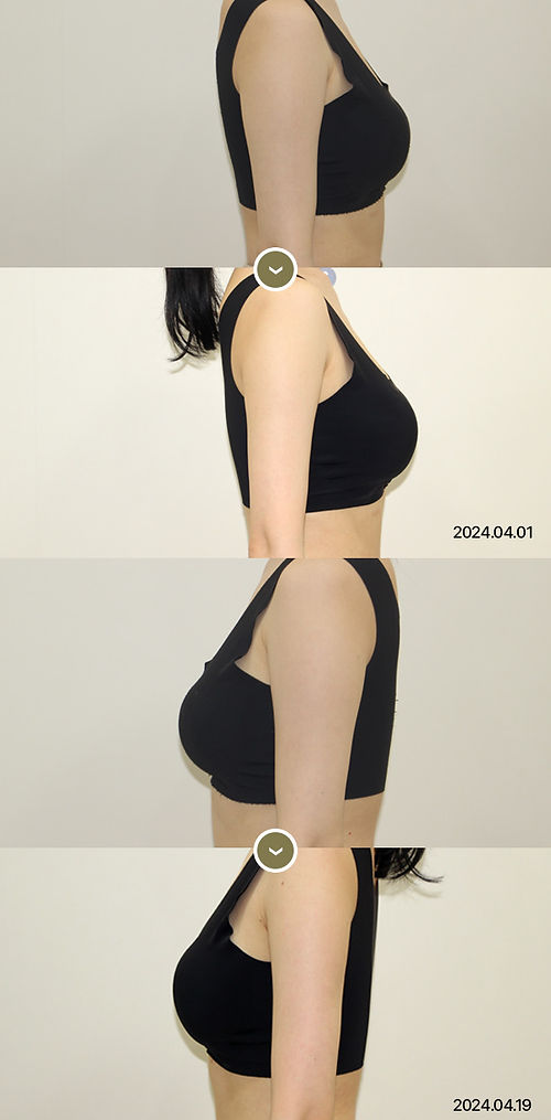 팔뚝_쉐잎주사5회