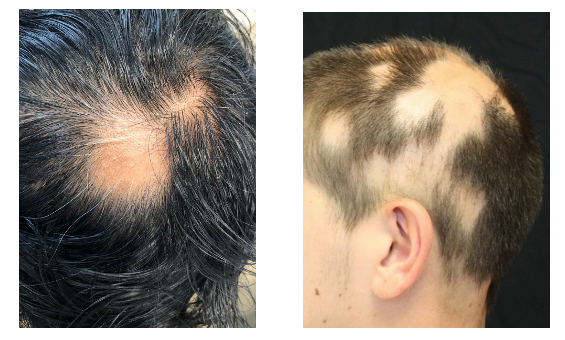 Hair Loss Treatment