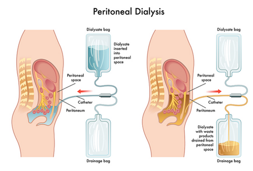 Peritoneal Dialysis: An Overview of a Life-Saving Treatment