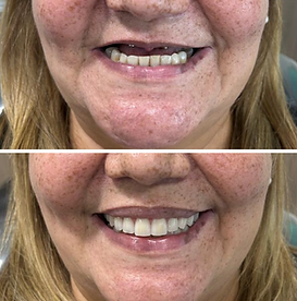 Resultado estético de implante dentário realizado na OdontoKay, Penha – São Paulo.