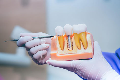 implantes-penha tatuape vila matilde.jpg