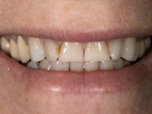 getting veneers at Meng Dental