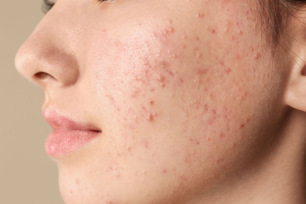 Làn da trước khi biết đến BeautiQ của Hồng Ngọc
