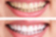 Miniatura: Blanqueamiento Dental