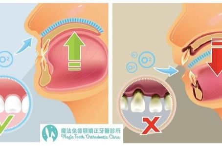 用嘴巴呼吸會引發牙周病?|陳敏傑醫師