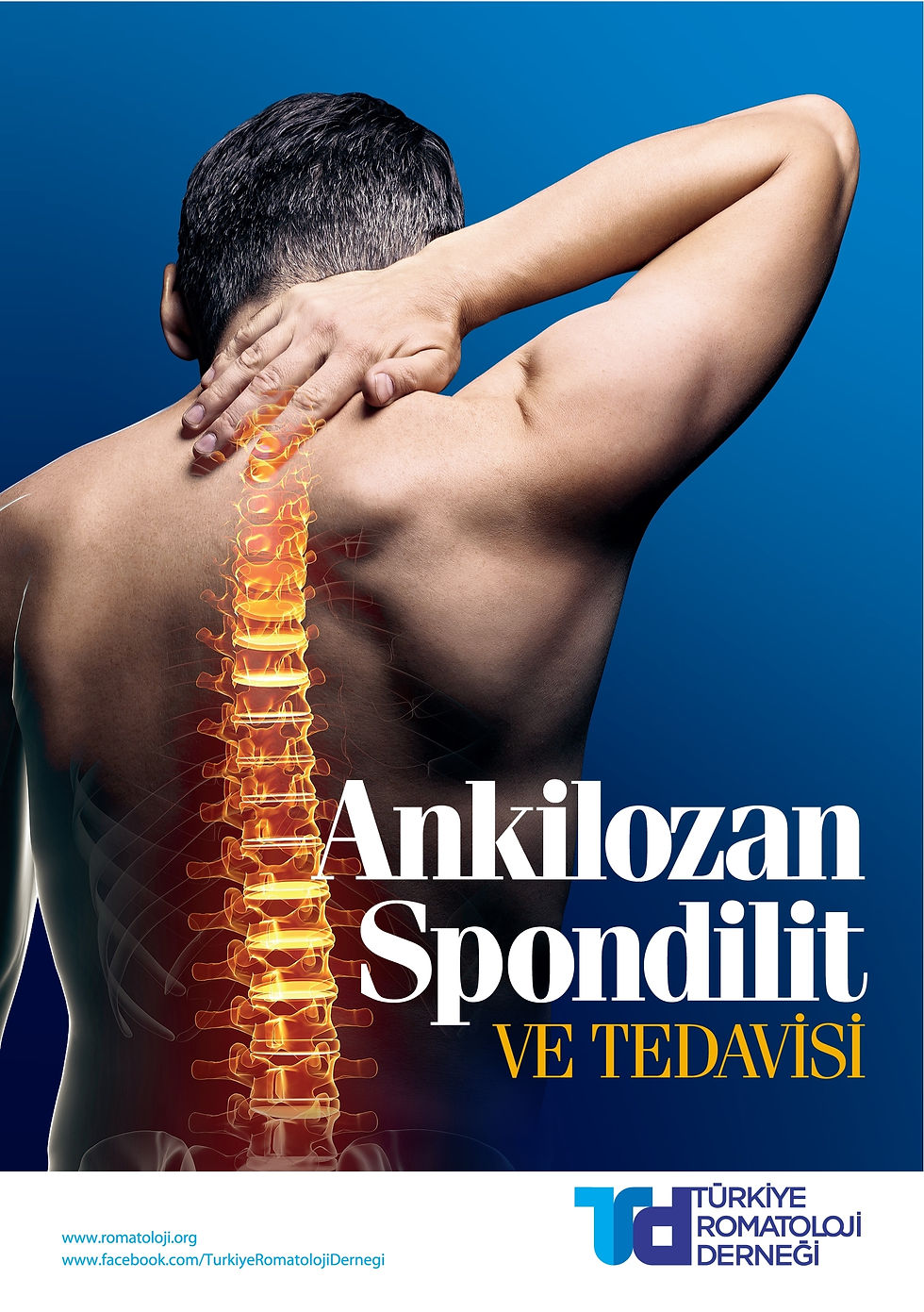 Ankilozan Spondilit