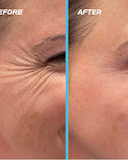 Crowfeet wrinkle tox treatment