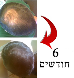 lipogaine results | תוצאות ליפוגיין