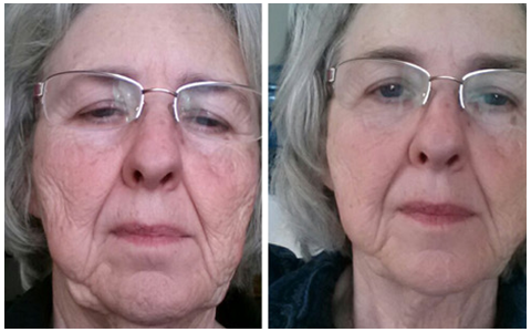 Red Light Face Lift results in 4 visits