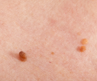 Konzultace pacienta před laserovým ošetřením kožních změn.