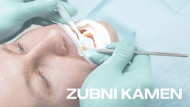 Zubní kámen: Jak vzniká