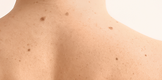 Lékařka provádí laserovou ablaci pigmentového névu Dermablate.