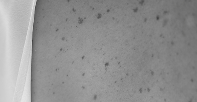 Dermatoskopické vyšetření znaménka před plánovaným zákrokem.