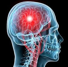 Concussions and Their Effect on The Teenage Brain