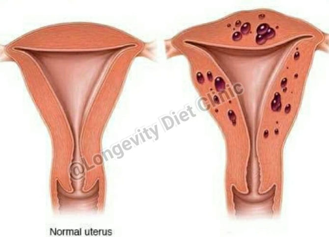 Case Study - Weight Loss & Hormone Balancing for Endometrial Hyperplasia