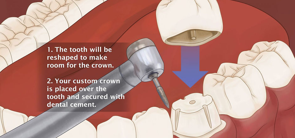 What-is-a-dental-crown-11-1536x862.jpg