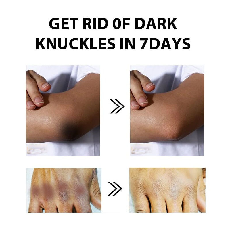 Miniatura: Gluta Master Removing stains Body Lotion Whitening Brightening Skin Knuckles Kn