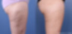 Morpheus8 Before & After Results