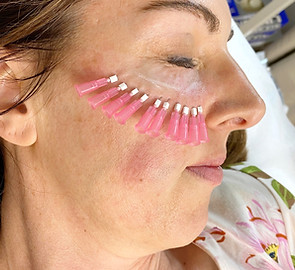 PDO mono threads, pdo threads, pdo threads melbourne, pdo threads near me, pdo threads before and after, best pdo threads, best pdo threads near me