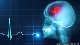 Neurological Effects of COVID-19