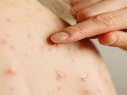 OPS llama a reforzar vacunación contra el sarampión