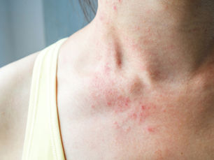 What causes worsening of eczema? A systematic review