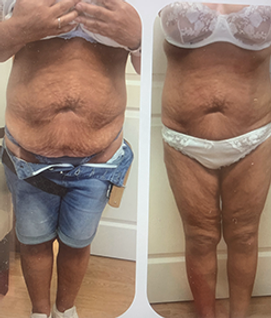 Oppstramming med cryo og strøm.png