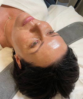 The Beauty Clinic - Mesotherapy - before and after 2.jpg