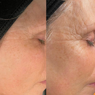 The Beauty Clinic - Chemical Peels - anti ageing-5.JPG