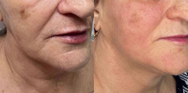 The Beauty Clinic - Mirconeedling - 3.JPG