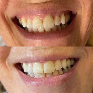 The Beauty Clinic - Anti Wrinkle Injections 20.JPG