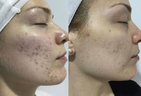 The Beauty Clinic - Mirconeedling - 8.JPG