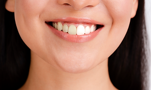 Ceramic Veneer.png