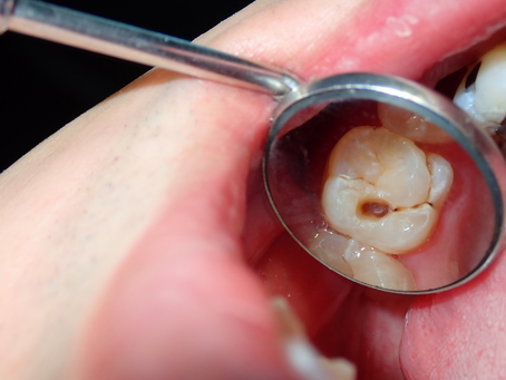 Dental Sealants: How They Protect Your Teeth & Prevent Cavities | Five Oaks Dental