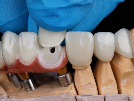 Top 5 Signs You Might Need a Dental Crown