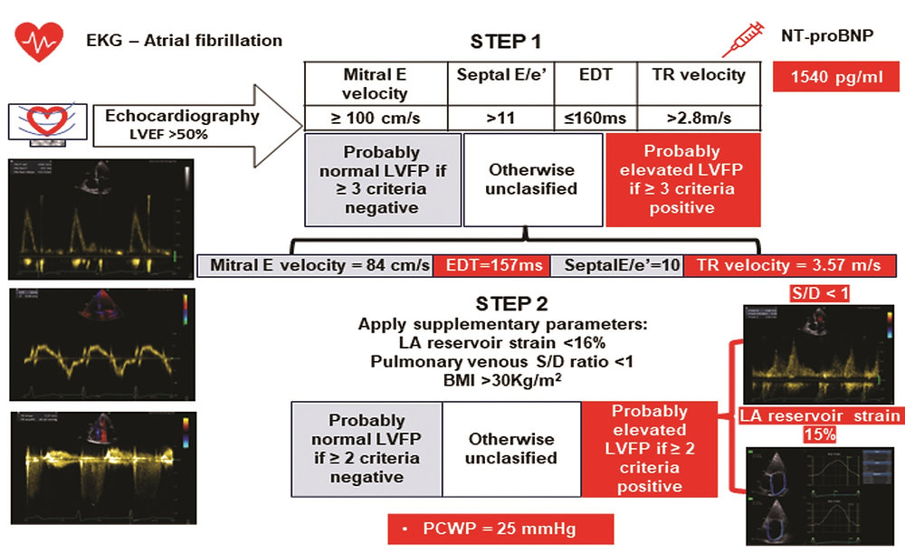 Diagnóstico de disfunción diastólica e insuficiencia cardíaca con ...