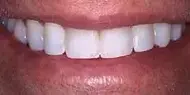 Teeth whitening near me