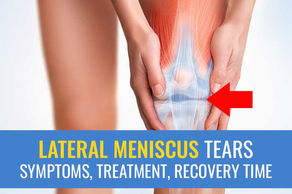 Lateral meniscus tears: Symptoms, treatment (surgery vs. exercise), and recovery time