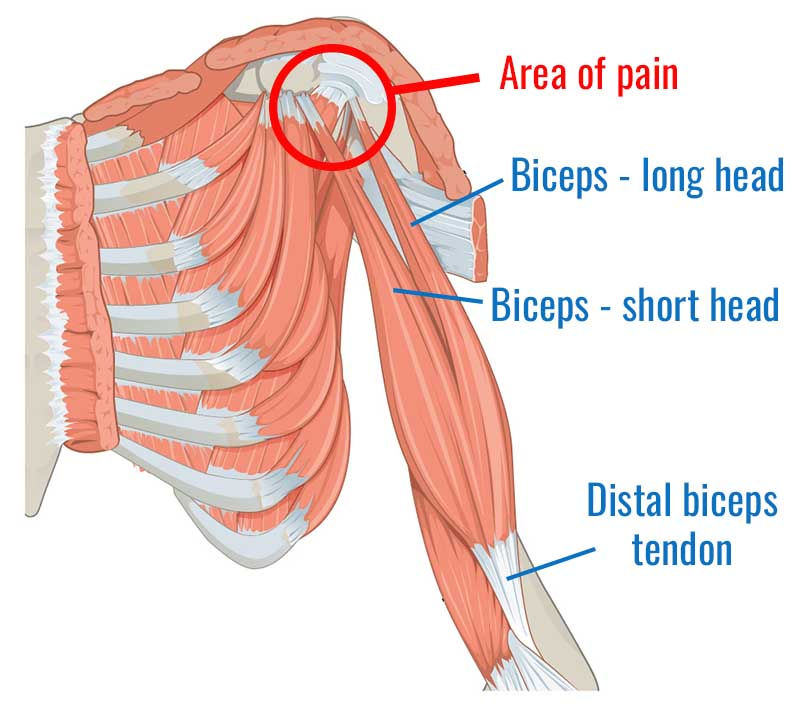 Therapy For Bicep Tendonitis At Robert Keck Blog Therapy For Bicep Tendonitis At Robert Keck Blog