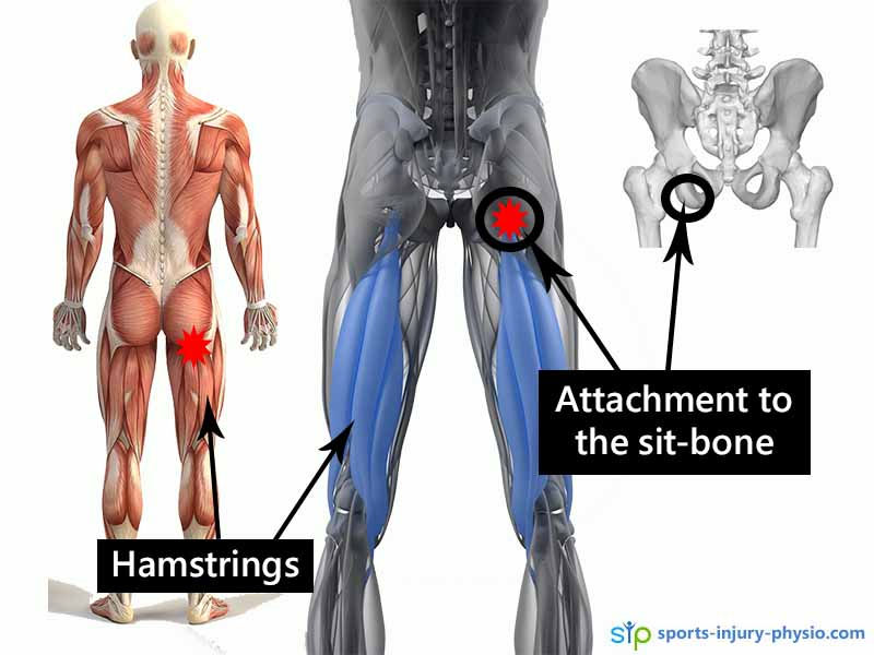 Proximal hamstring tendinopathy a common cause of butt pain in