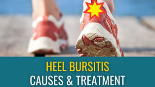 A closeup of the back of a person's feet as they are walking away from you with a yellow star on the back of one heel, indicating heel bursitis pain