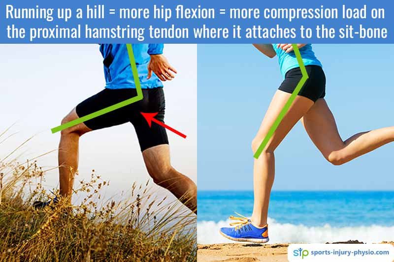 Proximal hamstring tendinopathy a common cause of butt pain in