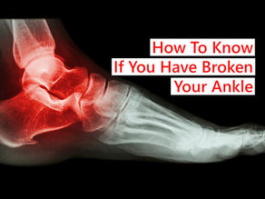 How to know whether you have a broken ankle