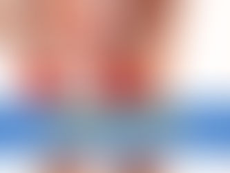 Meniscus tears: Causes, treatment options, and recovery time