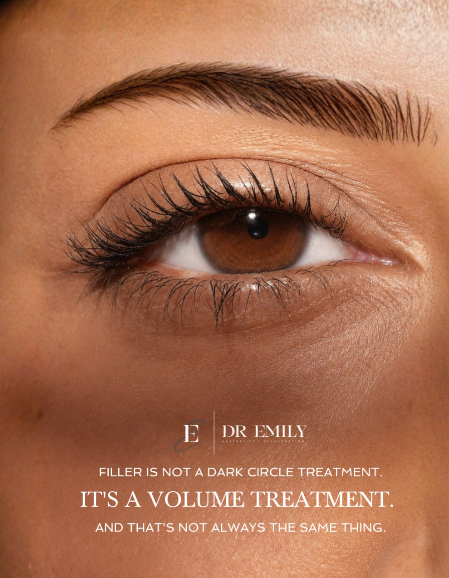 Under-eye ageing with dark circles and tear trough hollowing, illustrating why the under-eye ages first.