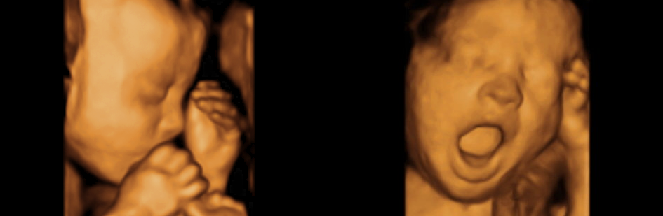 Diferencas Entre Ultrassom 3d 4d E Morfologica Precos