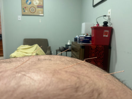 hanover county acupuncture