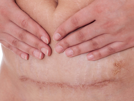 Say Goodbye to Unwanted Scars & Stretch Marks; skin camouflage scar removal